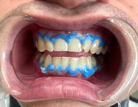 Избељивање зуба, 25. јануар 2024., Дуњадент